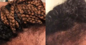 receding hairline braids